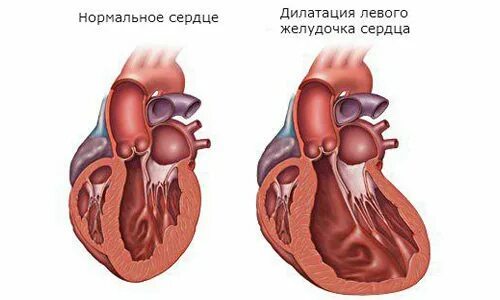 Желудочка сердца расширена. Дилатация ЛП сердца что это такое. Расширение камер сердца. Дилатация камер сердца. Дилатация левого желудочка.