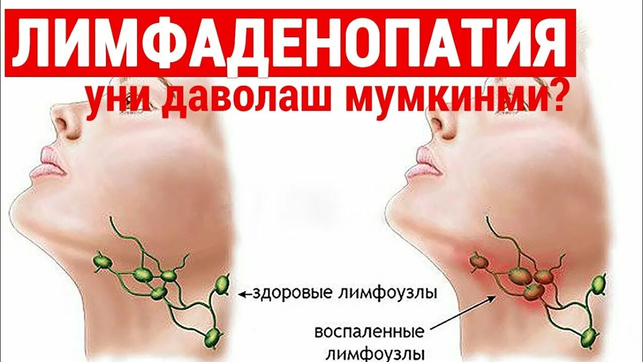 Лимфаденопатия что это такое у женщин. Лимфаденопатия что это такое у женщин