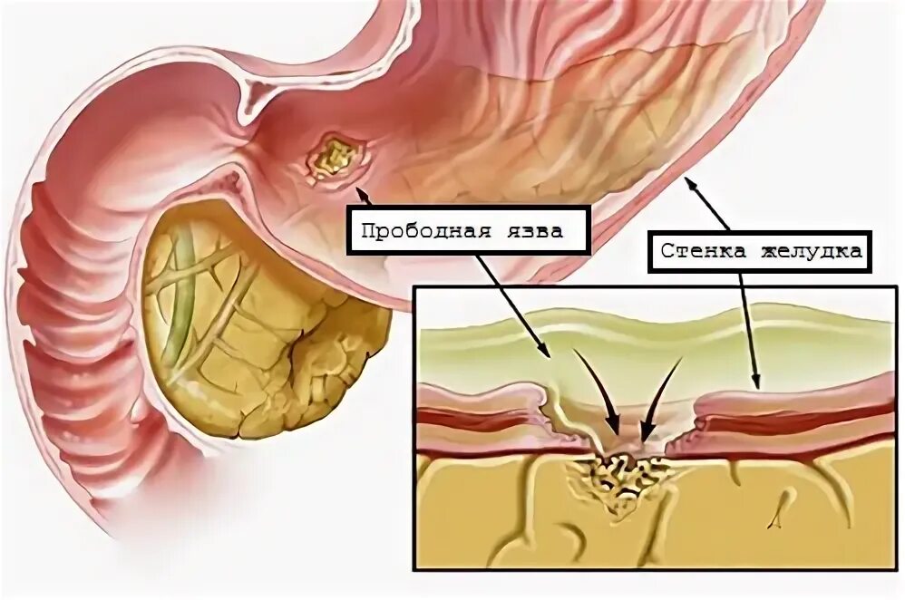 Послеоперационная язва. Осложнения прободной язвы желудка. Перфоративная язва двенадцатиперстной кишки. Язвенная болезнь желудка перфорация Пенетрация.