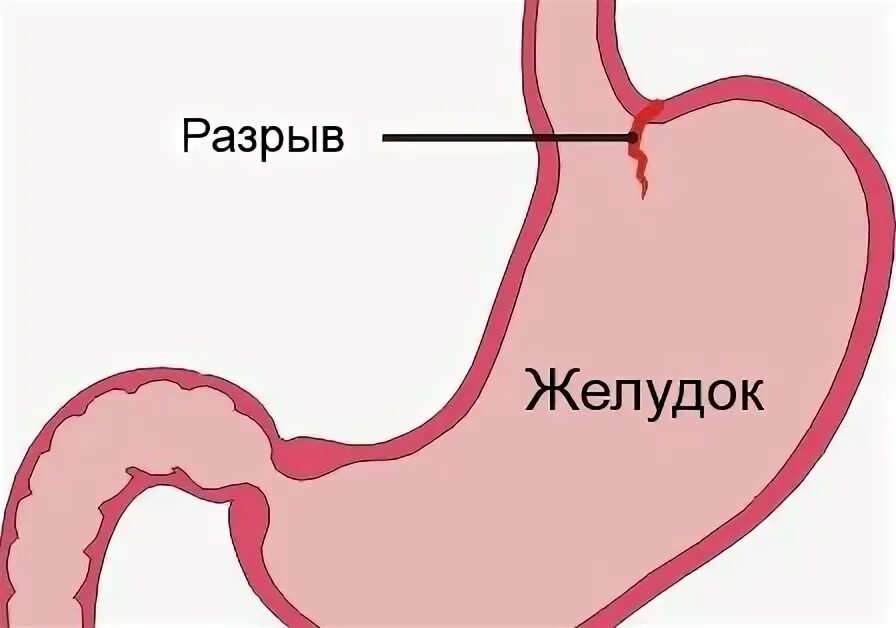 Скапливается воздух в желудке. Разрыв пищевода симптомы. Синдром Мэллори Вейса причина.