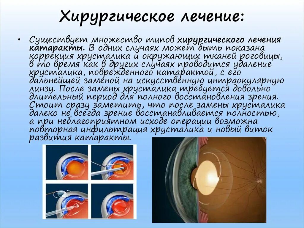 Презентация на тему катаракта. Сообщение на тему катаракта. Осложненная катаракта. Катаракта причины кратко.