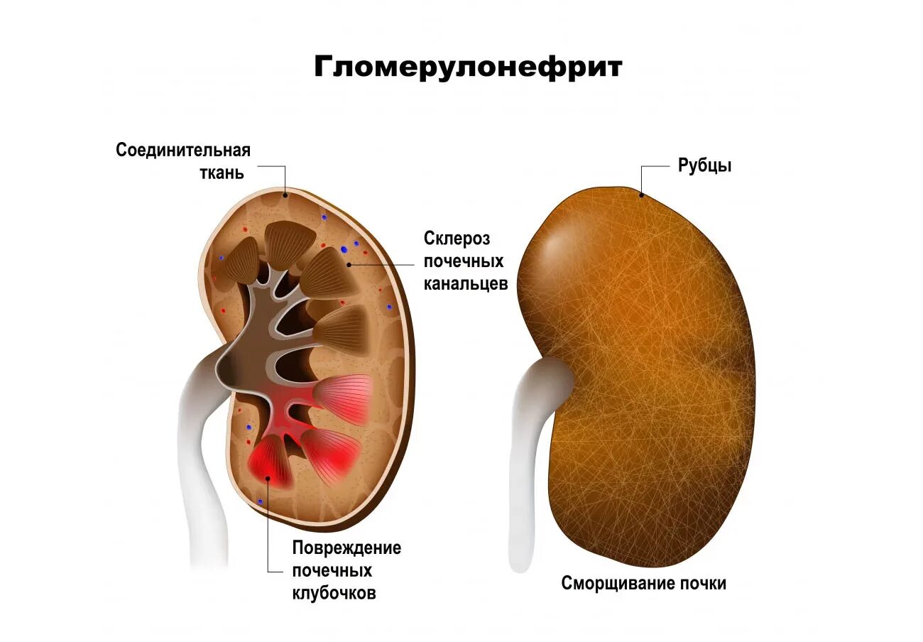 Гломерулонефрит больница. Гломерулонефрит почка. гломерулонефрит биопсия. гломерулонефрит картинки.