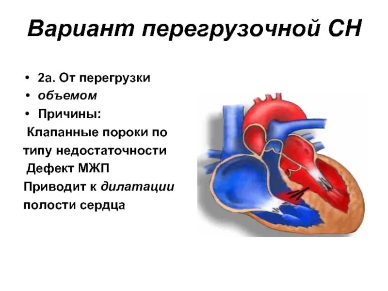 Дилатация правых отделов сердца. Дефект межжелудочковой перегородки сердца. Дилатация полостей сердца. Расширение камер сердца. Дилатация полостей предсердий