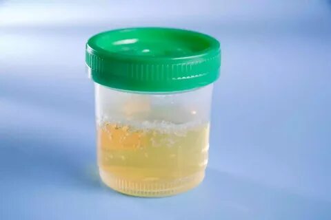 Que pasa cuando la sale orina sale blanca