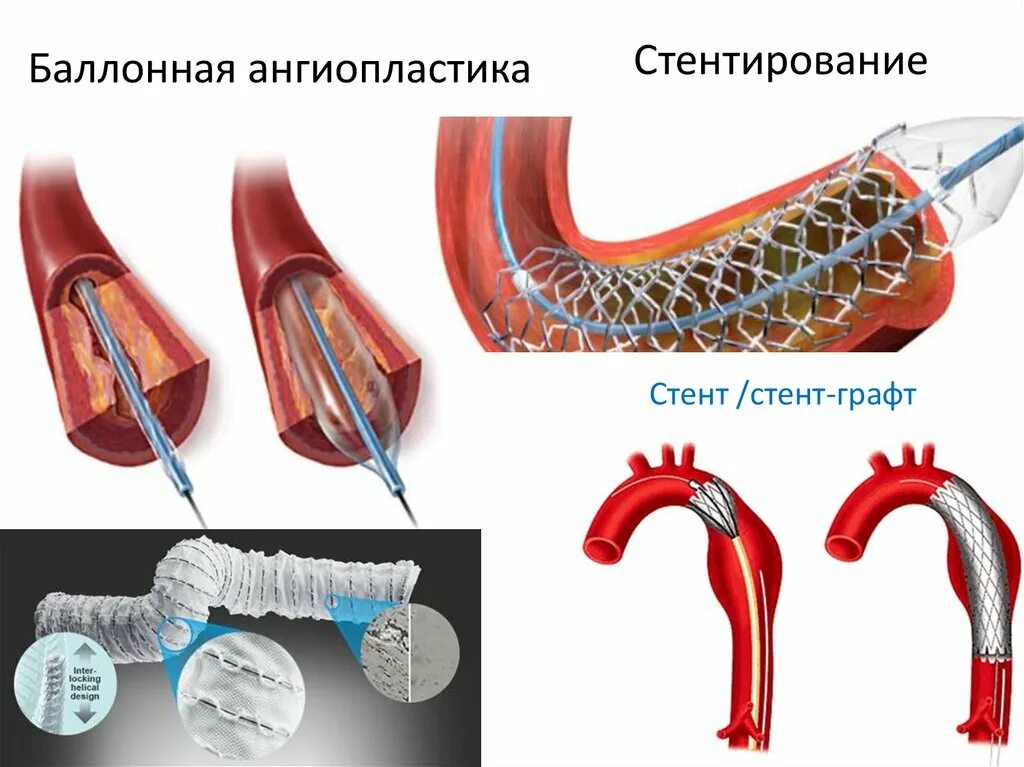 Как ставят стент