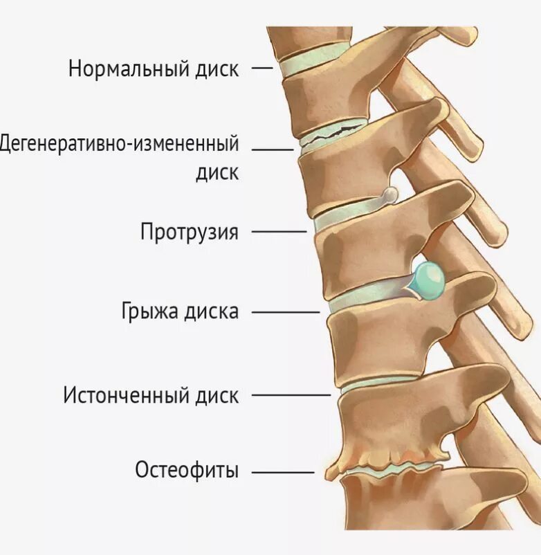 Остеохондроз какие степени