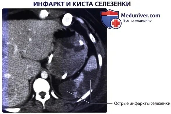 Киста селезенки лечение. Паразитарная киста селезенки на кт.