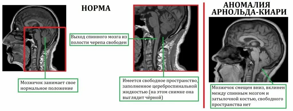 Полости мозга заполнены. Аномалия Арнольда Киари 1 мрт. Аномалия Киари 1 типа на мрт. Картина аномалии Арнольда Киари 1 типа. Аномалия Киари 2 типа мрт.