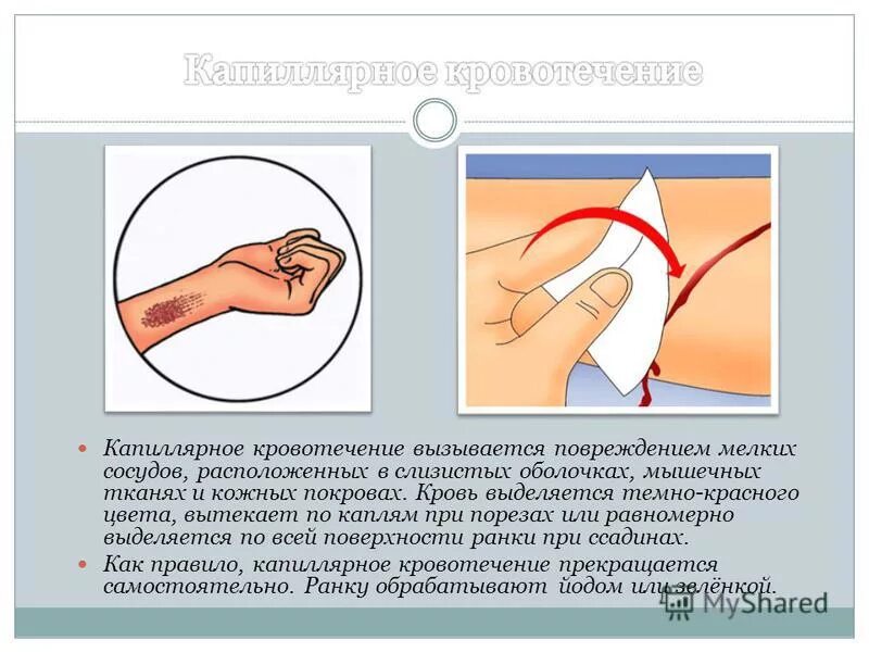 Капиллярная кровь. Капиллярное кровотечение. Капилярноекровотечение. Капиллярное кровотечение рисунок. Капиллярная кровотечение останавливается.