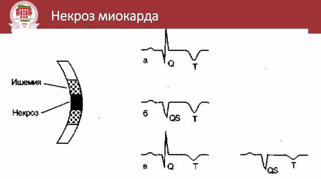 Изменение зубца q. Патологический зубец q на ЭКГ при инфаркте миокарда. Некроз миокарда на ЭКГ. Зона некроза на ЭКГ при инфаркте миокарда. Патологический зубец q на ЭКГ.