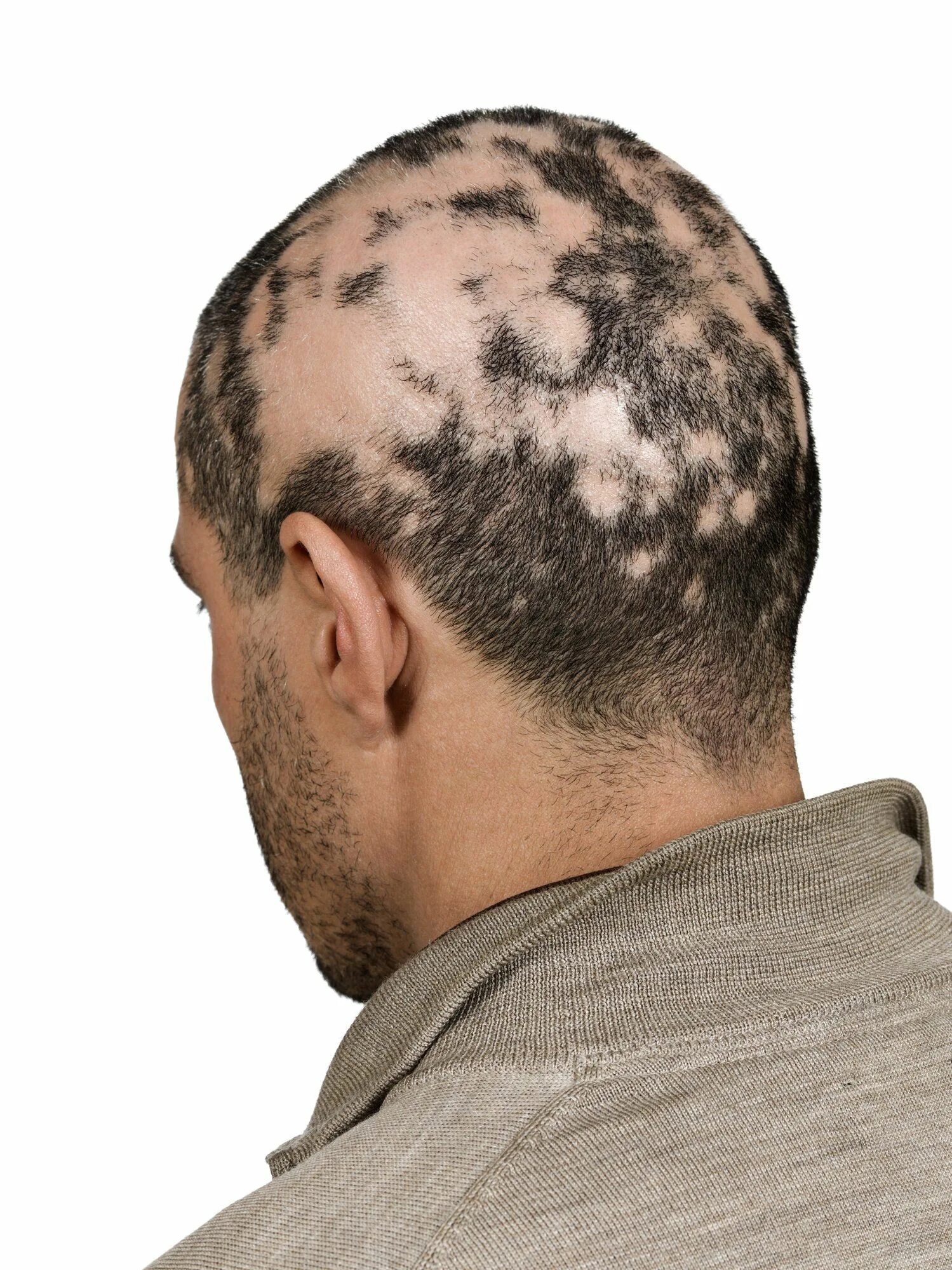 Заболевания затылка. Очаговая (гнездная) алопеция. Очаговая алопеция (alopecia Areata).