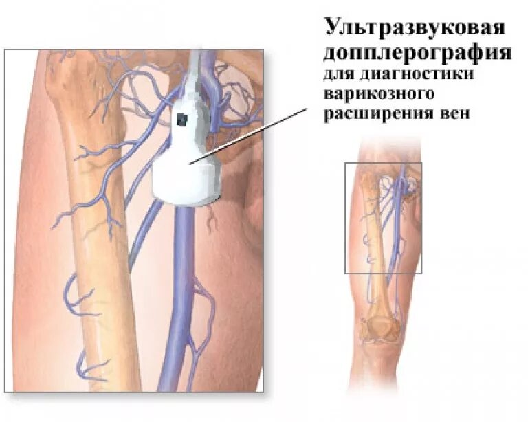 Диагноз расширение вен. Ультразвуковая допплерография вен нижних конечностей. Ультразвуковая допплерография сосудов нижних конечностей. УЗДГ сосудов (артерий и вен) нижних конечностей. УЗИ вен нижних конечностей варикоз.