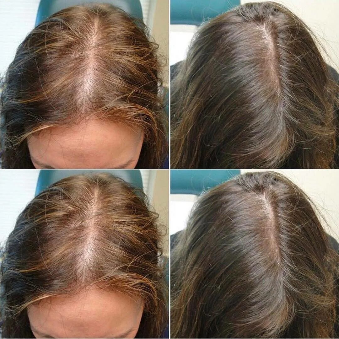 Мезотерапия для волос. Мезотерапия волос до и после. Мезотерапия для кожи головы и волос. Мезотерапия волос головы до и после. Выпадают волосы после операции
