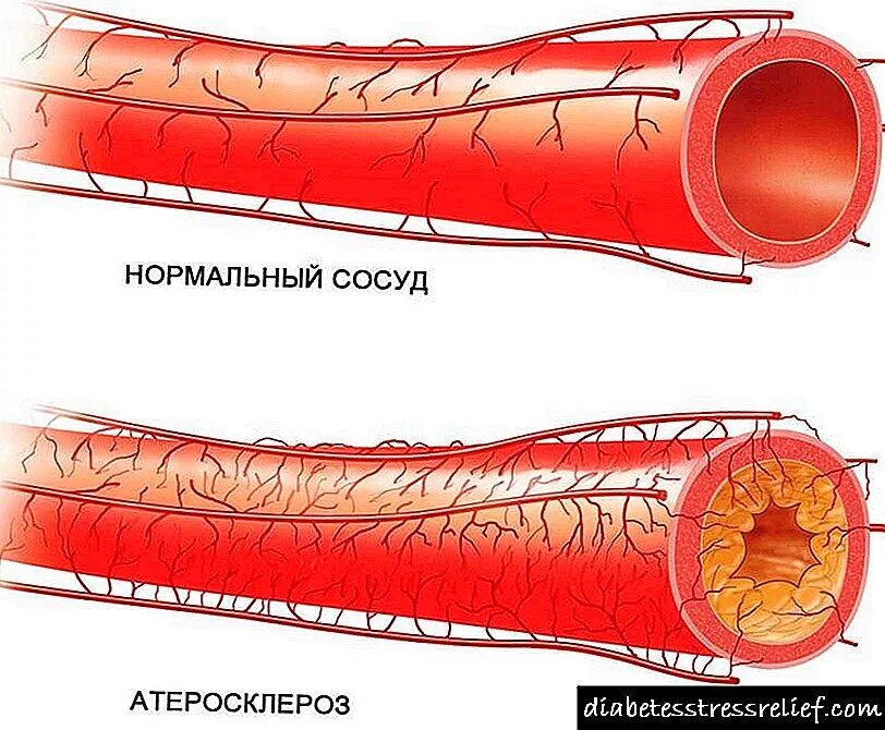Сосудистый атеросклероз. Сосудистый атеросклероз