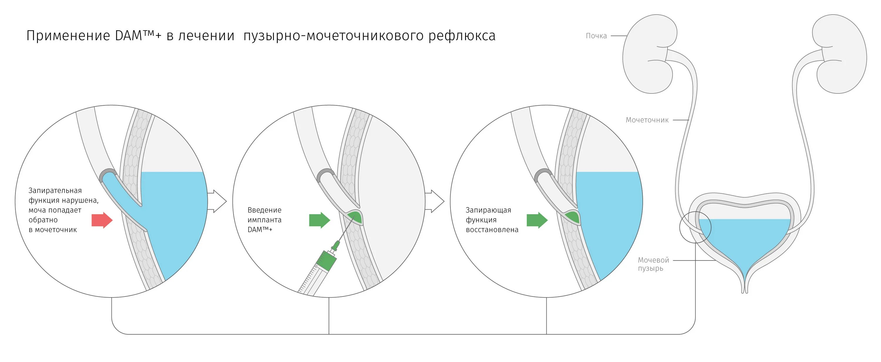 Рефлюкс мочи. Мочеточниково-пузырный рефлюкс. Эндоскопическая коррекция пузырно-мочеточникового рефлюкса. Причины пузырно мочеточникового рефлюкса. Операции при пузырно мочеточниковом рефлюксе.