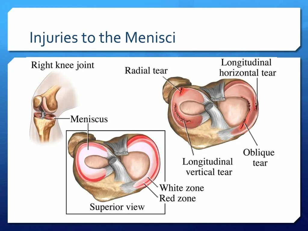 Рога мениска коленного сустава. Разрыв поперечной связки мениска. Дегенеративные изменения менисков коленного. Столлер классификация менисков. Столлер классификация менисков.