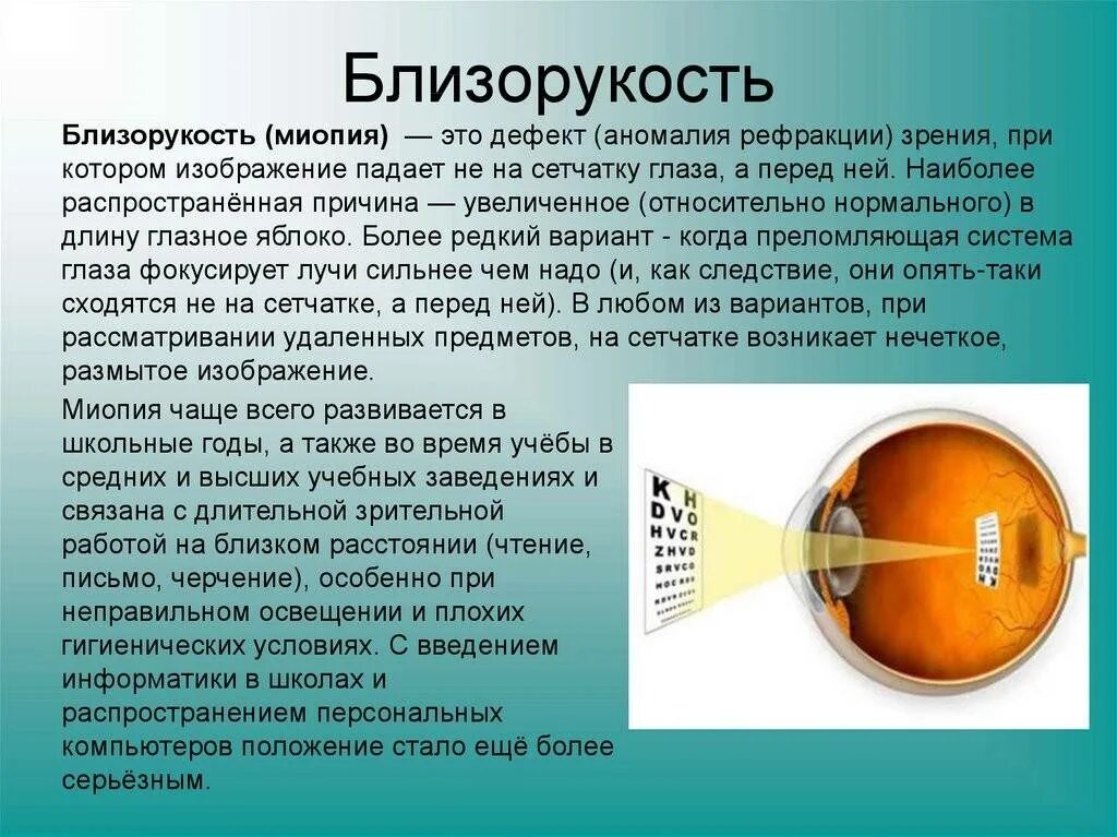 Близорукость. Близорукость миопия. Заболевание глаз миопия. Заболевание органов зрения миопия. Миопия у ребенка форум