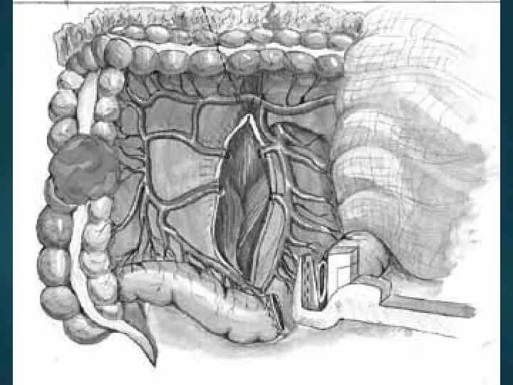 Правосторонняя гемиколэктомия. Гемиколэктомия кишечника. Гемиколэктомия ход операции. Левосторонняя гемиколэктомия. Колэктомия это