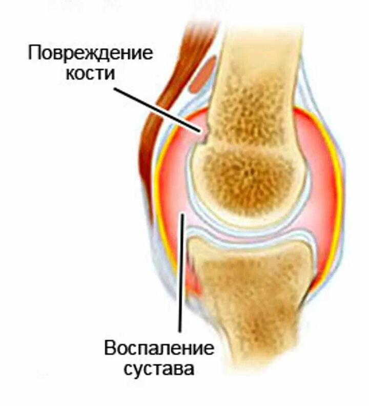 Усиленные суставы. Ревматический артрит коленного сустава. Псориатический артрит коленного сустава. Артрит и артроз коленного сустава. Подагрический артрит коленного сустава.