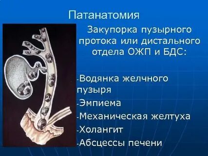 Холелитиаз это