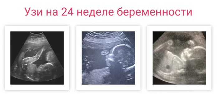 Почему на 24 недели. Параметры плода 24 недели. УЗИ 24 недели беременности.