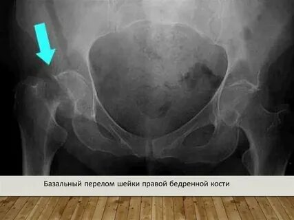 Перелом шейки таза