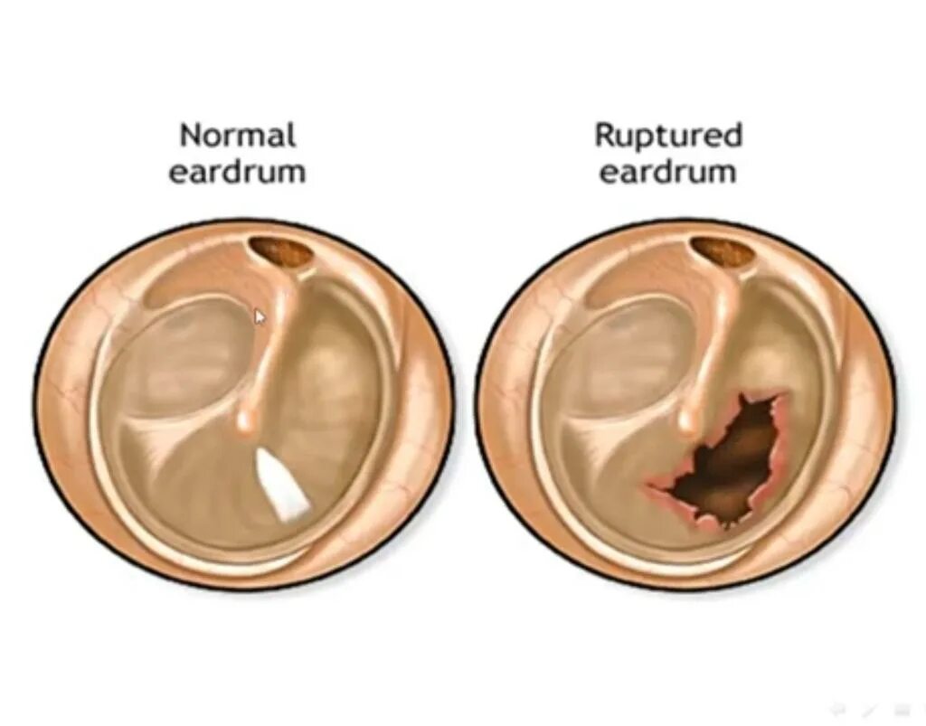 Перфорация барабанной перепонки отоскопия. Гнойный отит барабанная перепонка. Барабанная перепонка отоскопия. Мезотимпанит барабанная перепонка.