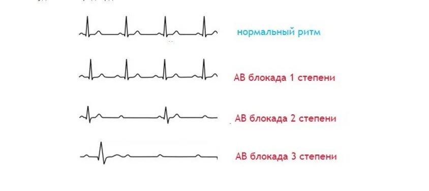 Блокада узла. Атриовентрикулярная блокада 3 степени на ЭКГ. АВ блокада 3 степени на ЭКГ. ЭКГ при АВ блокаде 3 степени. Полная АВ блокада 3 степени ЭКГ.