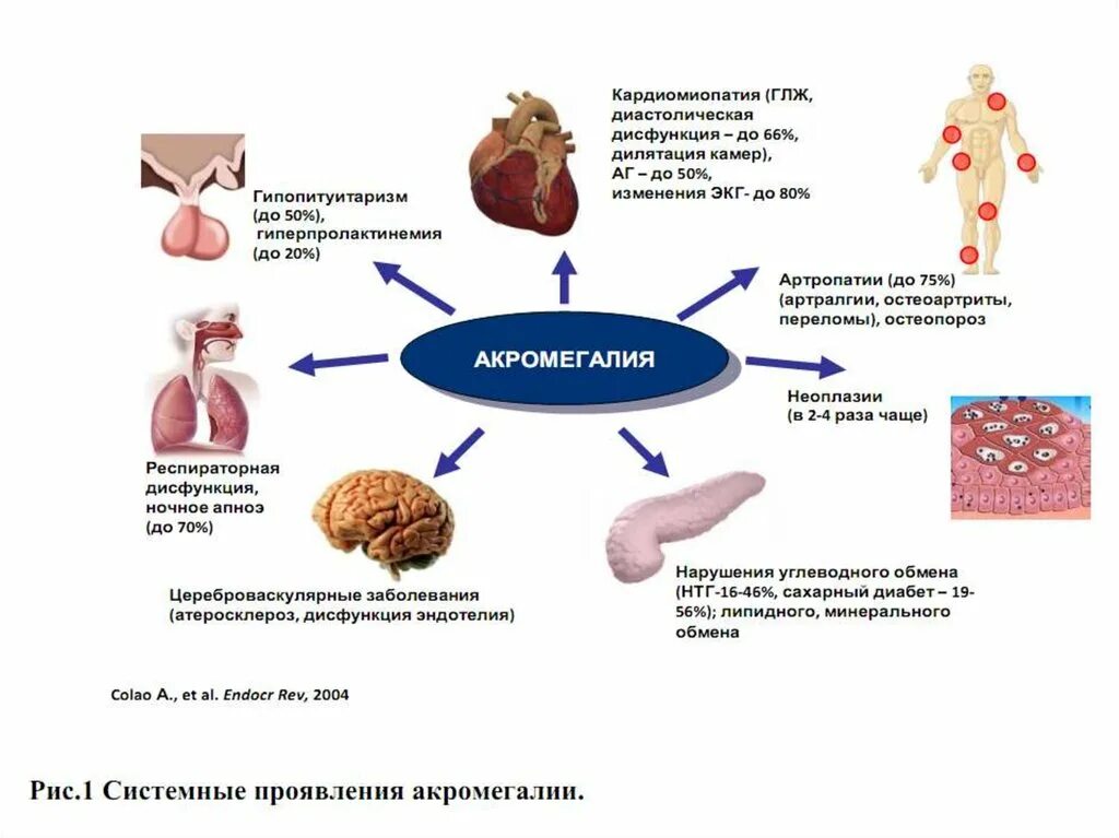 Увеличение пролактина. Акромегалия механизм развития. Акромегалия патогенез эндокринология. Акромегалия этиология патогенез клиника. Акромегалия пропедевтика внутренних болезней.