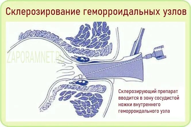 Ректальные операции. Склерозирование внутренних геморроидальных узлов. Склеротерапия внутренних геморроидальных узлов. Наружные узлы склерозирование. Склерозирование геморроя.