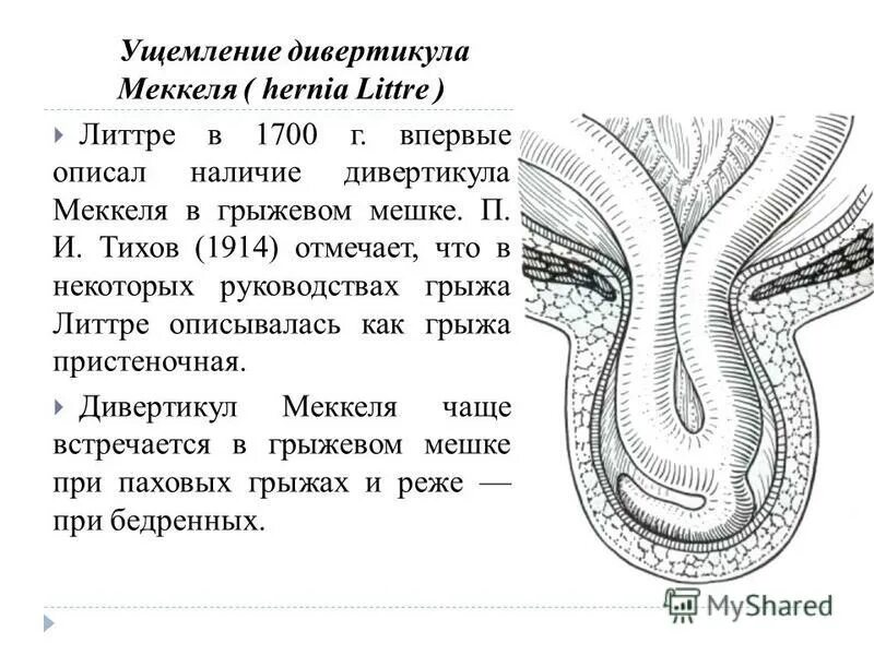 грыжа литтре ущемление. грыжа брока мнимое ущемление. атипичные формы ущемления. ущемленная грыжа рихтера литре. ущемление дивертикула меккеля грыжа литтре.