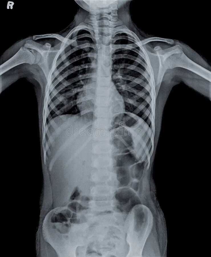 Discoid atelectasis XRAY. Футболка с рентгеном грудной клетки.