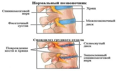 Симптомы причины и лечение спондилеза