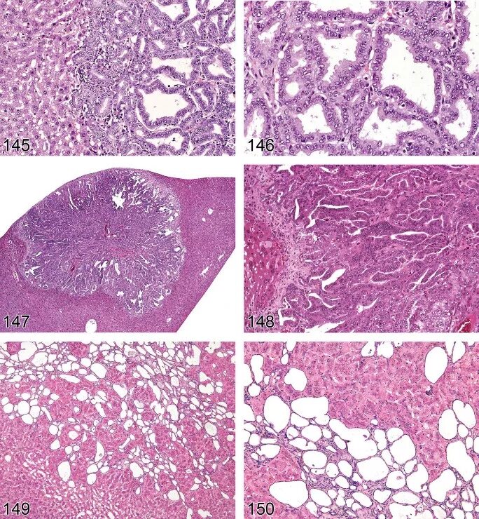 Гистология холангиокарциномы. Холангиокарцинома Патан. Холангиокарцинома микропрепарат. Патоморфология холангиокарцинома печени. Что такое стеатоз поджелудочной железы