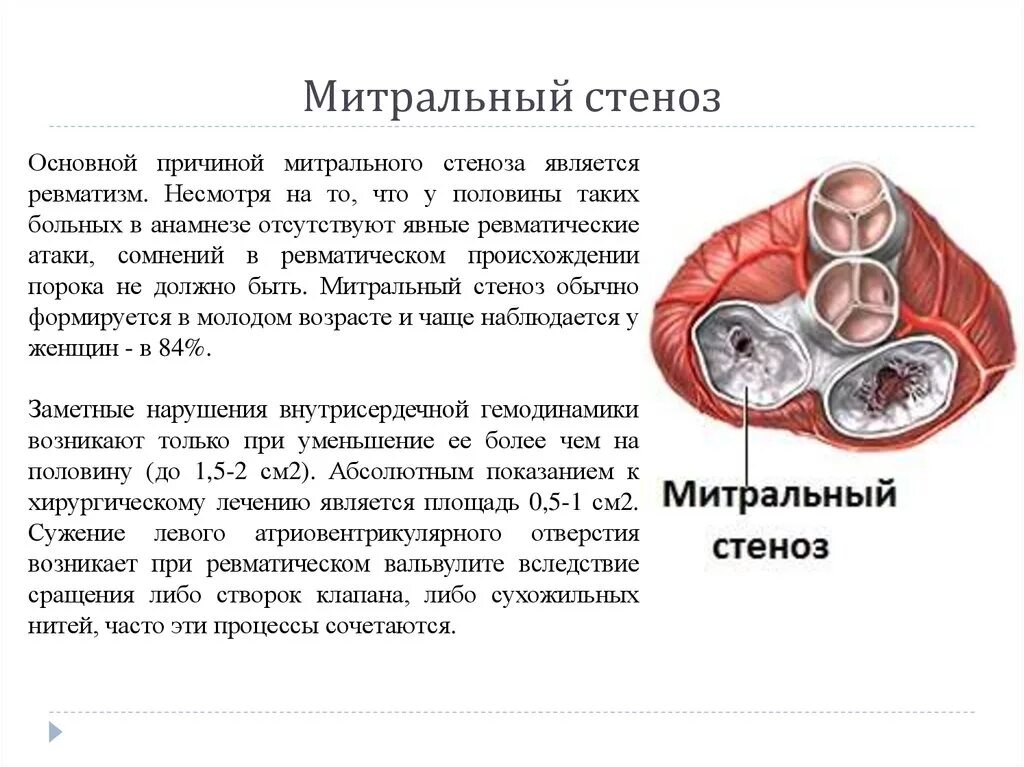 Стеноз митрального клапана сердца. Ревматизм и стеноз митрального клапана. Ревматический стеноз митрального клапана. Клинические симптомы митрального стеноза. Митральный стеноз признаки