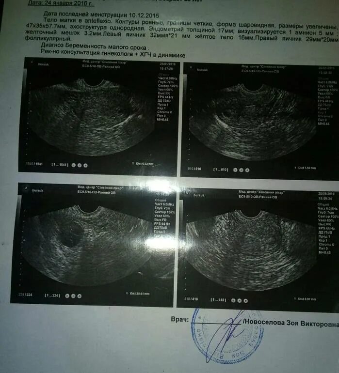 Жёлтое тело диаметром 5 мм. УЗИ беременности 5 недель эндометрий. УЗИ 4 недели беременности желтое тело. Матка на 32 неделе беременности