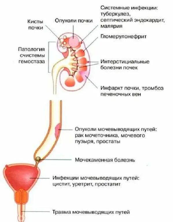 После мочевого. Мочевой пузырь кровь в моче. Моча с кровью у мужчин причины.