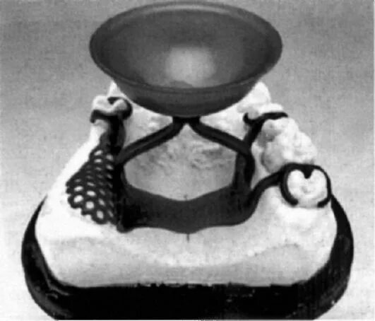 Литниковая система в стоматологии муфта. Литниковая система бюгельного протеза. Литниковая система в стоматологии муфта. Литниковая система каркаса бюгельного протеза. Литниковая система каркаса бюгельного протеза.