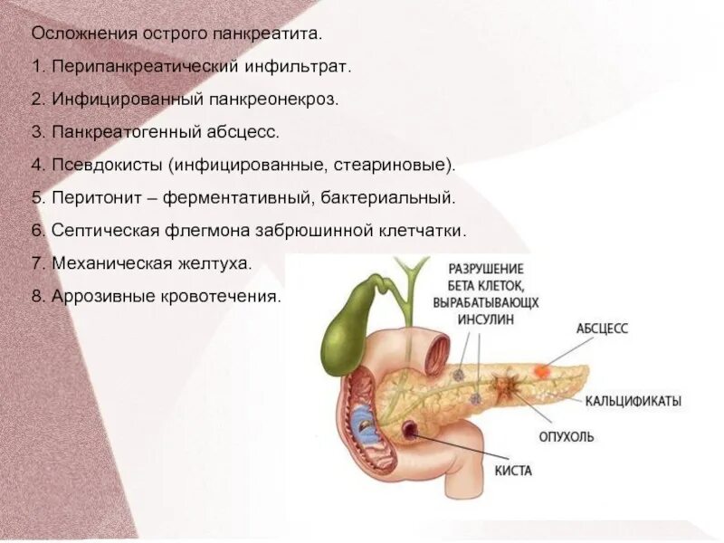 От чего появляется панкреатит. Острый панкреатит хронический панкреатит. Основные осложнения острого панкреатита. Осложнения острый панкреатит панкреонекроз.