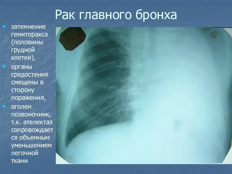 Затемнение грудной клетки