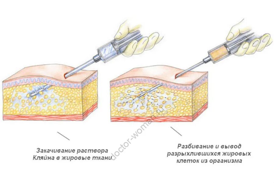 Как называется удаление жира