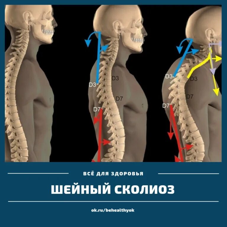 Шейный отдел сглажен. Кифоз лордоз грудного отдела позвоночника. кифоз шейно грудного отдела позвоночника. лордоз и кифоз шейного отдела. искривление позвоночника лордоз.