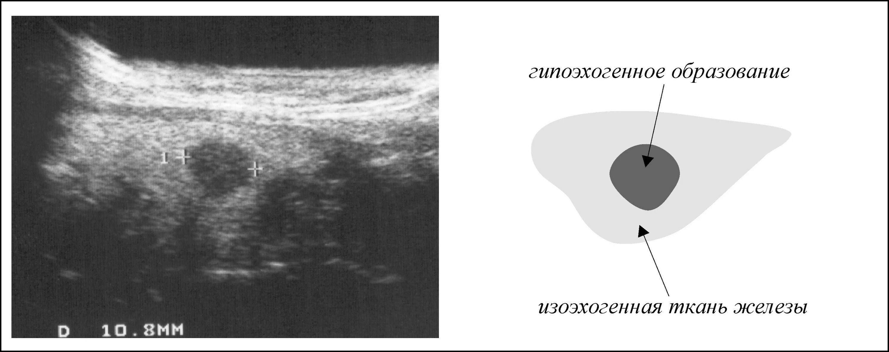 Изоэхогенное образование щитовидной железы УЗИ. Изоэхогенное образование щитовидной железы с гипоэхогенным ободком. Гипоэхогенный узел ЦДК щитовидной железы УЗИ. Гипоэхогенные узлы на УЗИ щитовидной железы.