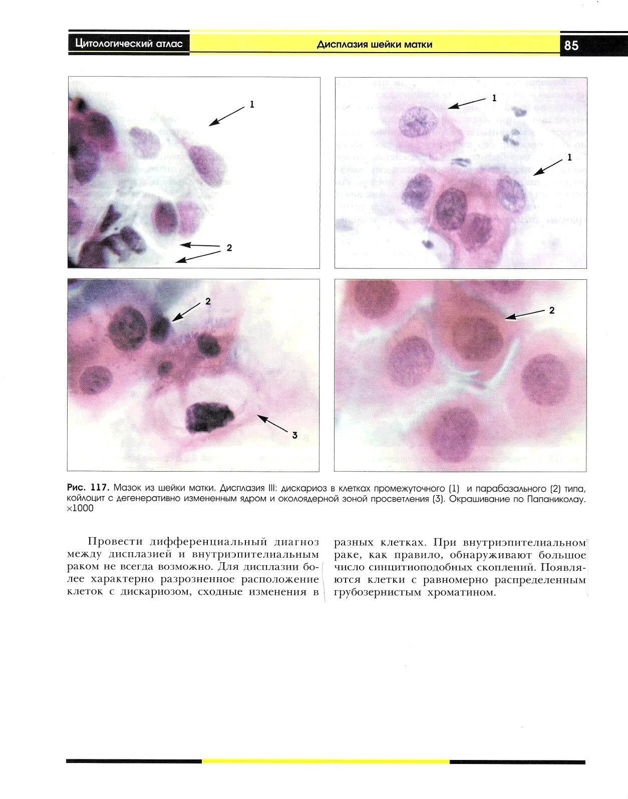Воспаление с реактивными изменениями клеток. Цитологическое исследование гинекологических мазков. Цитологический атлас заболеваний шейки матки Шабалова. Шабалова цитологический атлас диагностика заболеваний шейки матки. Цитологическое исследование влагалищного мазка.
