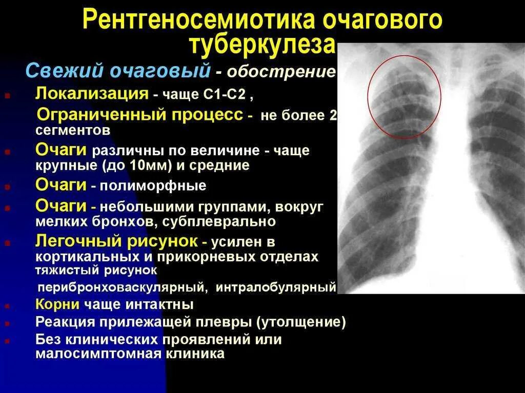 Очаги в нижней доле легкого. Очаговая форма туберкулеза рентген. Туберкулез плевры рентген. Инфильтративный туберкулез верхней доли рентген. Очаговый туберкулез рентген.