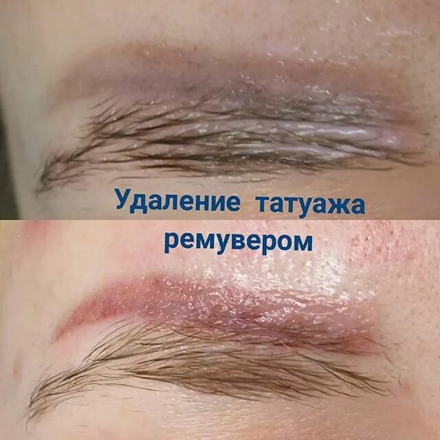 ремувер до и после брови. лазерное выведение татуажа бровей. удаление бровей ремувером. заживление после ремувера на бровях. ремувер до и после брови.