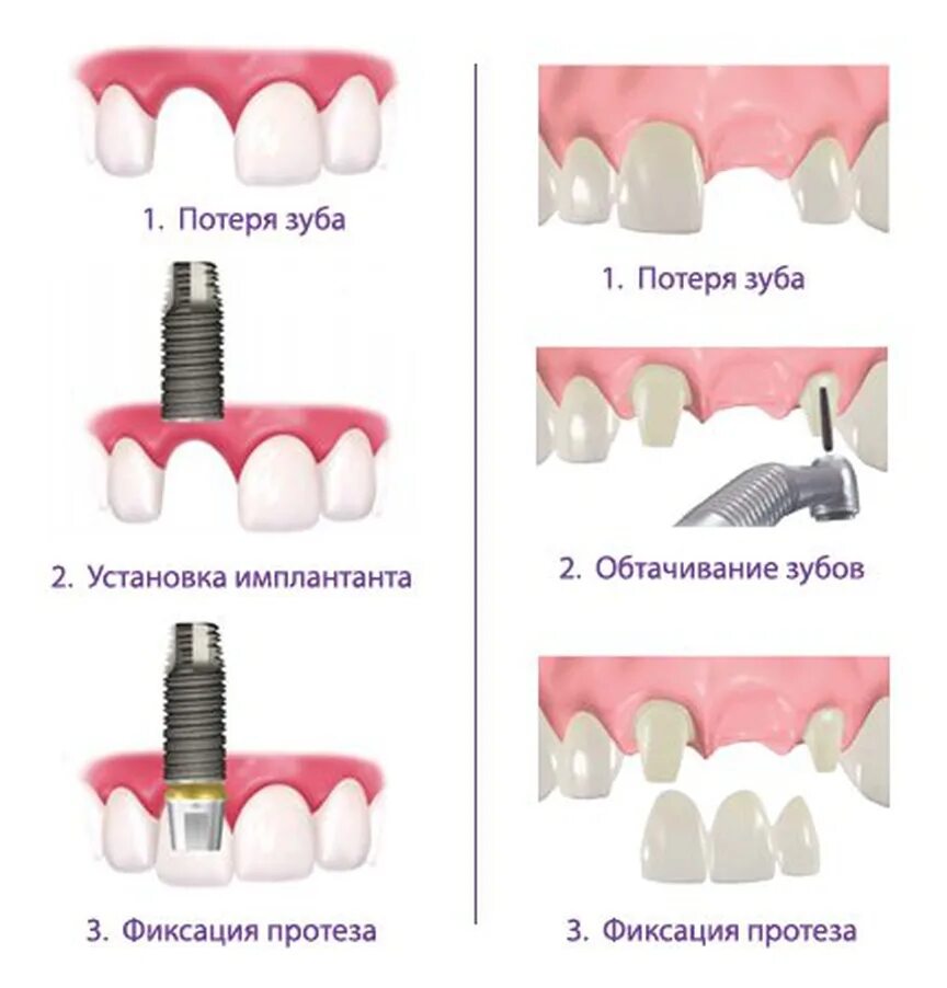 Протезирование зубов виды. Имплант и протез зуба разница. Схема установки съёмного протеза на импланты. Виды протезирования зубов схема.
