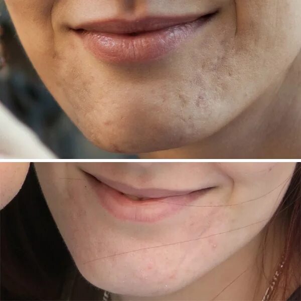 заполнение рубца филлером. заполнение шрама филлером. биоревитализация лица постакне. шрам филлером. шрам филлером.