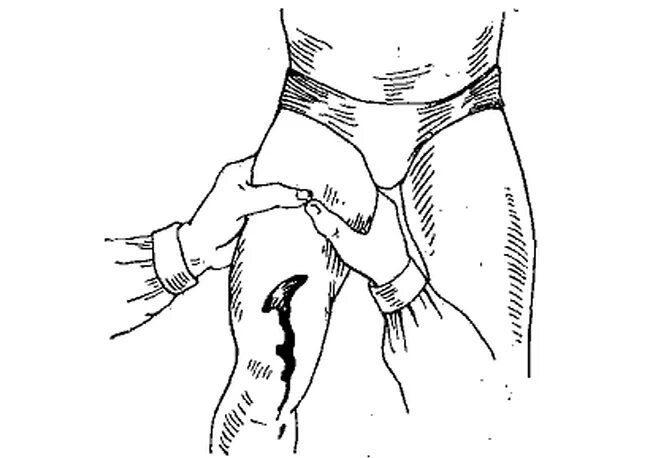 Пальцевое прижатие сосудов бедренная артерия. Прижатие бедренной артерии пальцевое прижатие. Пальцевое прижатие артерий бедренной артерии. Пальцевое прижатие бедренной артерии выполняется.