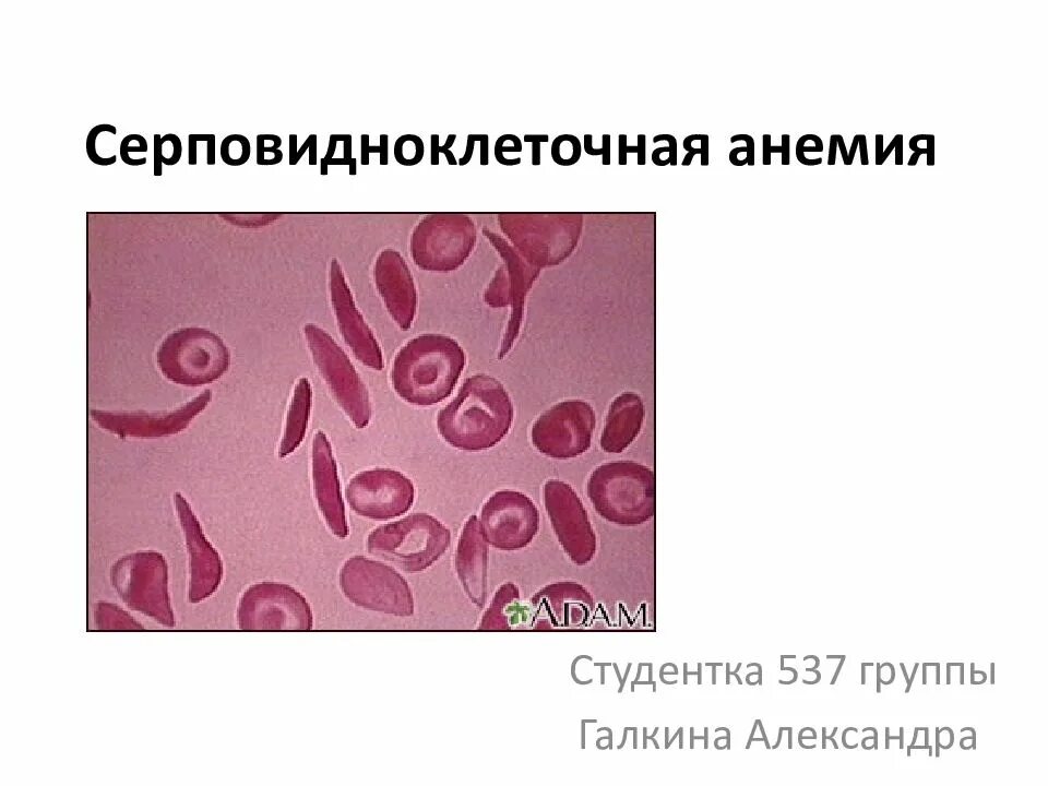 Серповидноклеточная анемия какая. Серповидноклеточная анемия гистология. Серповидноклеточная анемия мазок крови. Серповитоклеточная аннемич. Серповидно-клеточная анемия человека.